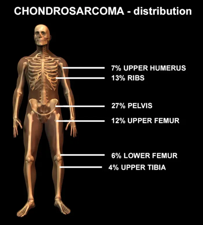 Chondrosarcoma Cancer Signs and Symptoms